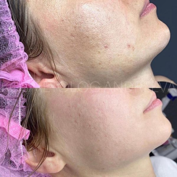 Chemical-peels7jpg