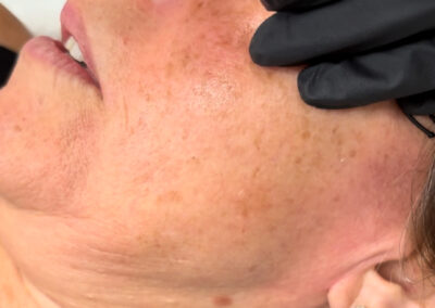 Vascular laser treatment before-and-after gallery photo at LuXe Concierge Aesthetics, Davie FL