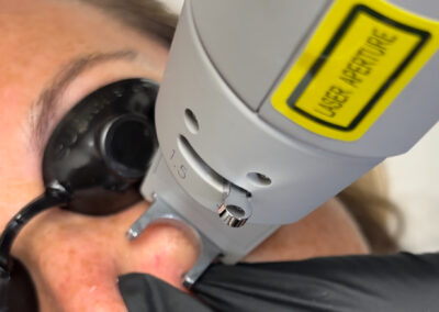 Vascular laser treatment before-and-after gallery photo at LuXe Concierge Aesthetics, Davie FL