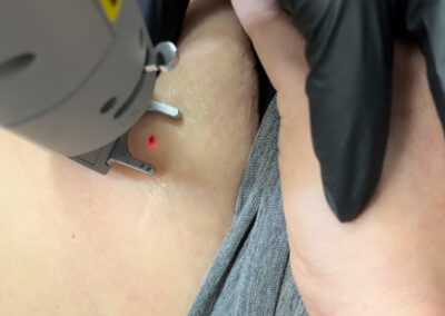 Vascular laser treatment before-and-after gallery photo at LuXe Concierge Aesthetics, Davie FL