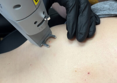 Vascular laser treatment before-and-after gallery photo at LuXe Concierge Aesthetics, Davie FL