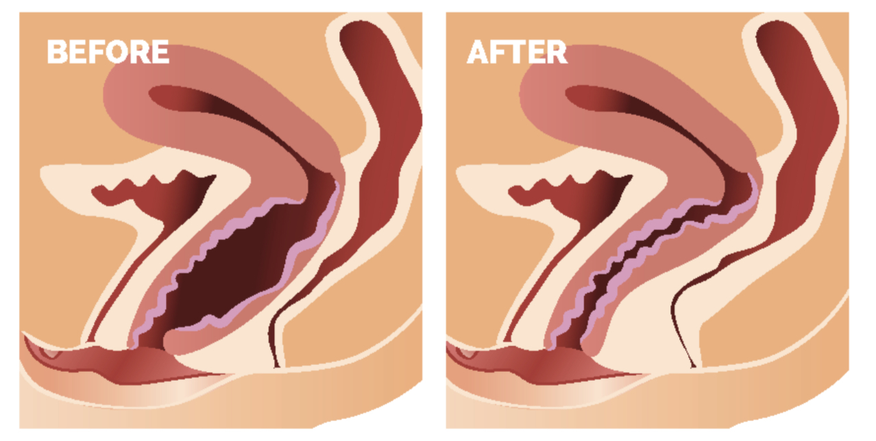 Non-surgical vaginal rejuvenation before and after illustration — tighter, restored vaginal tissue at LuXe Concierge Aesthetics, Davie FL