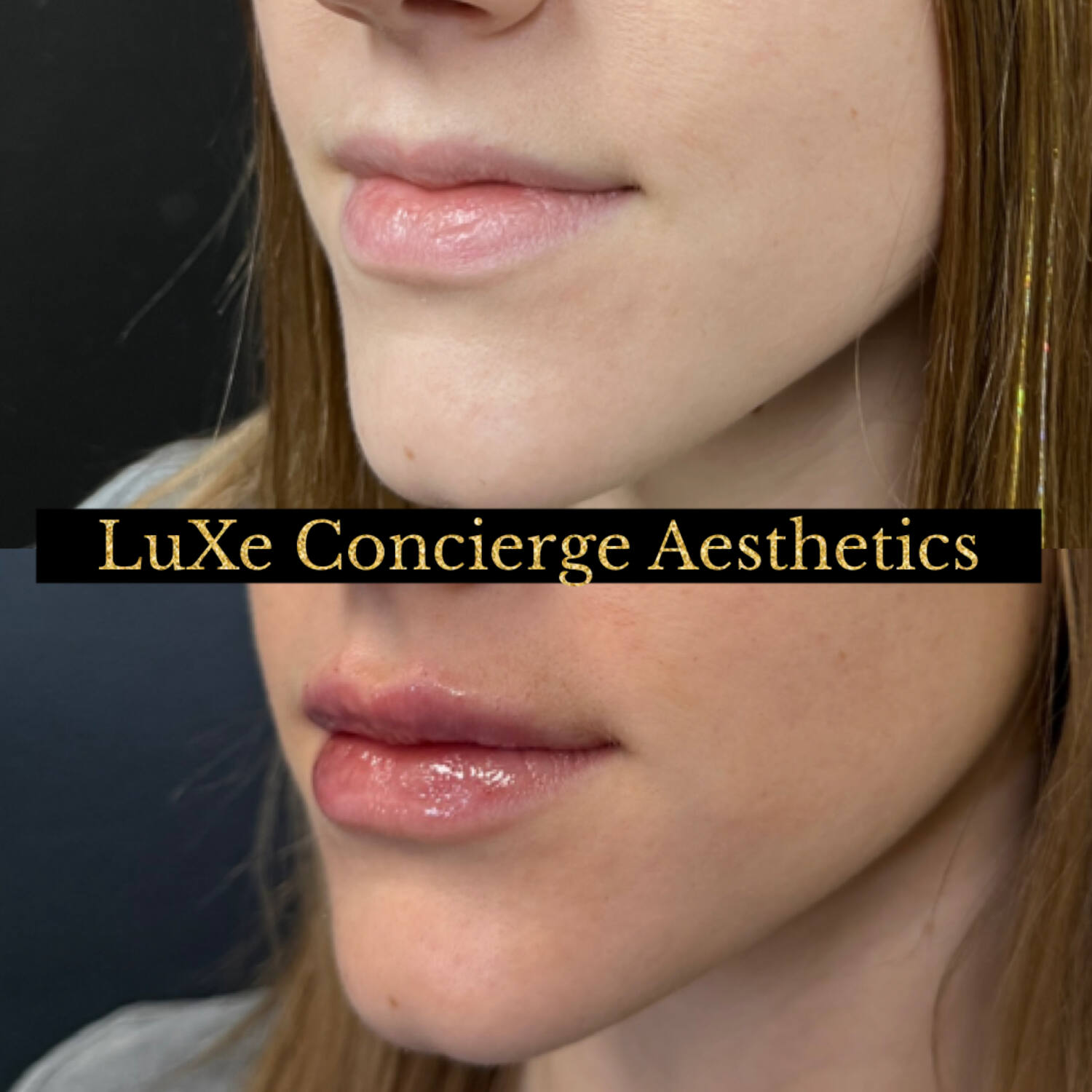 Dermal filler and facial balancing before and after at LuXe Concierge Aesthetics, Davie FL