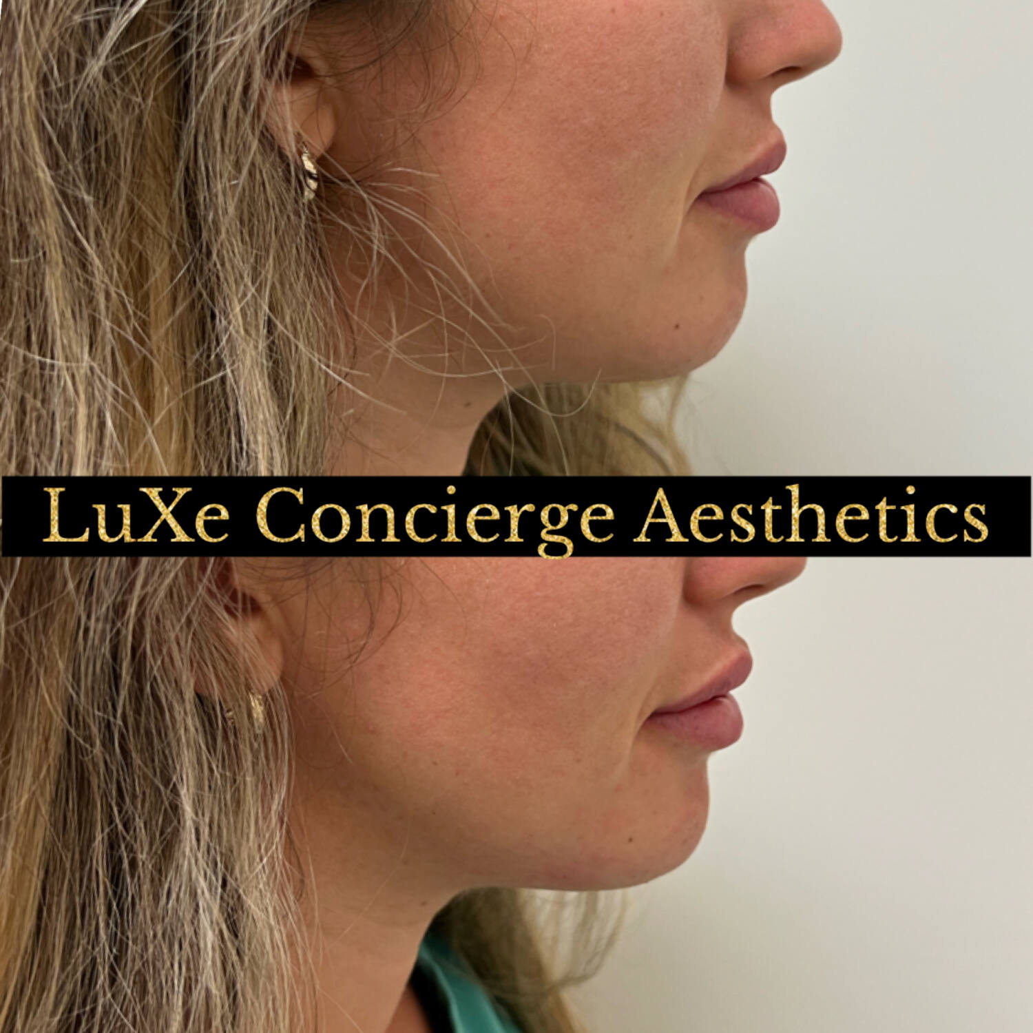 Dermal filler and facial balancing before and after at LuXe Concierge Aesthetics, Davie FL