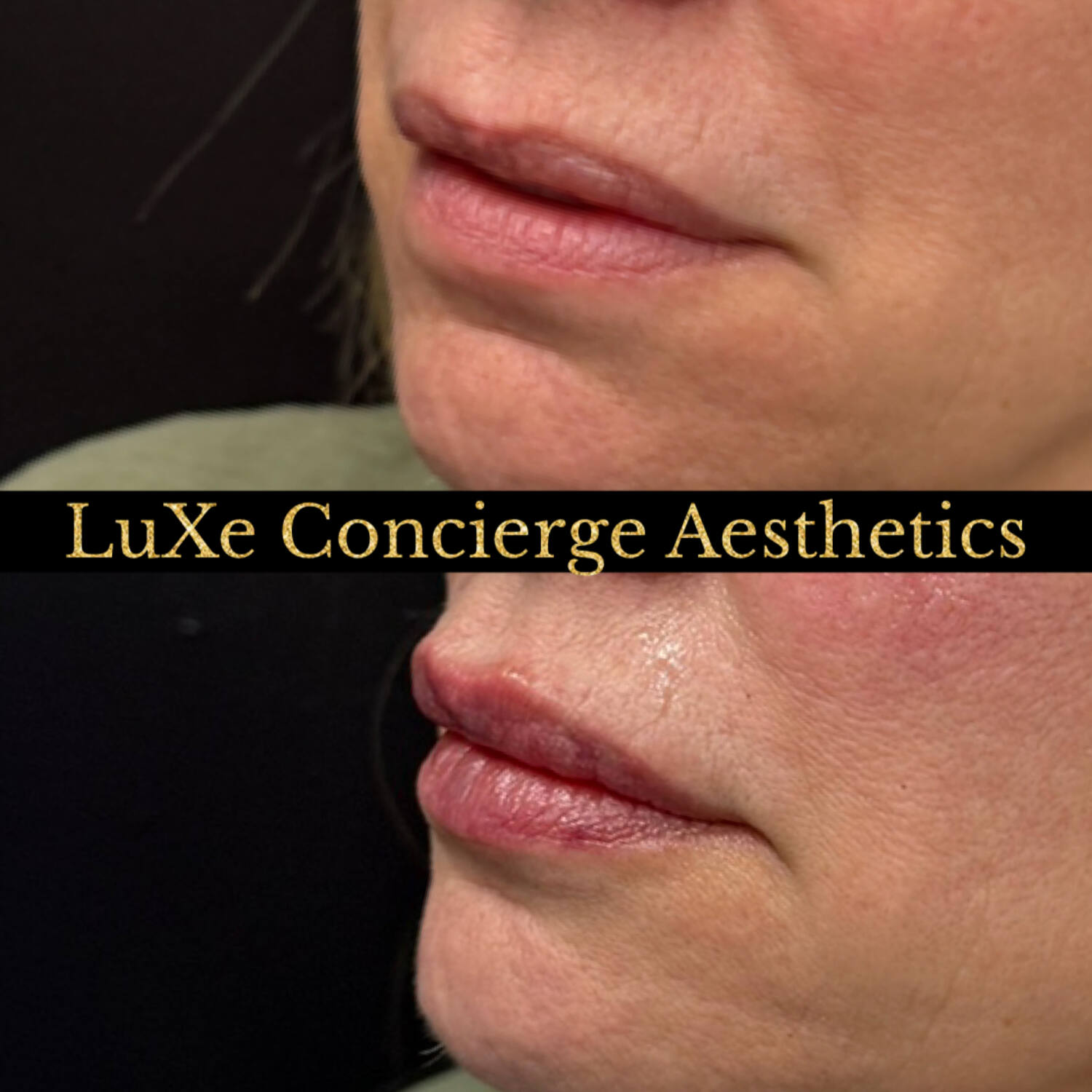 Dermal filler and facial balancing before and after at LuXe Concierge Aesthetics, Davie FL