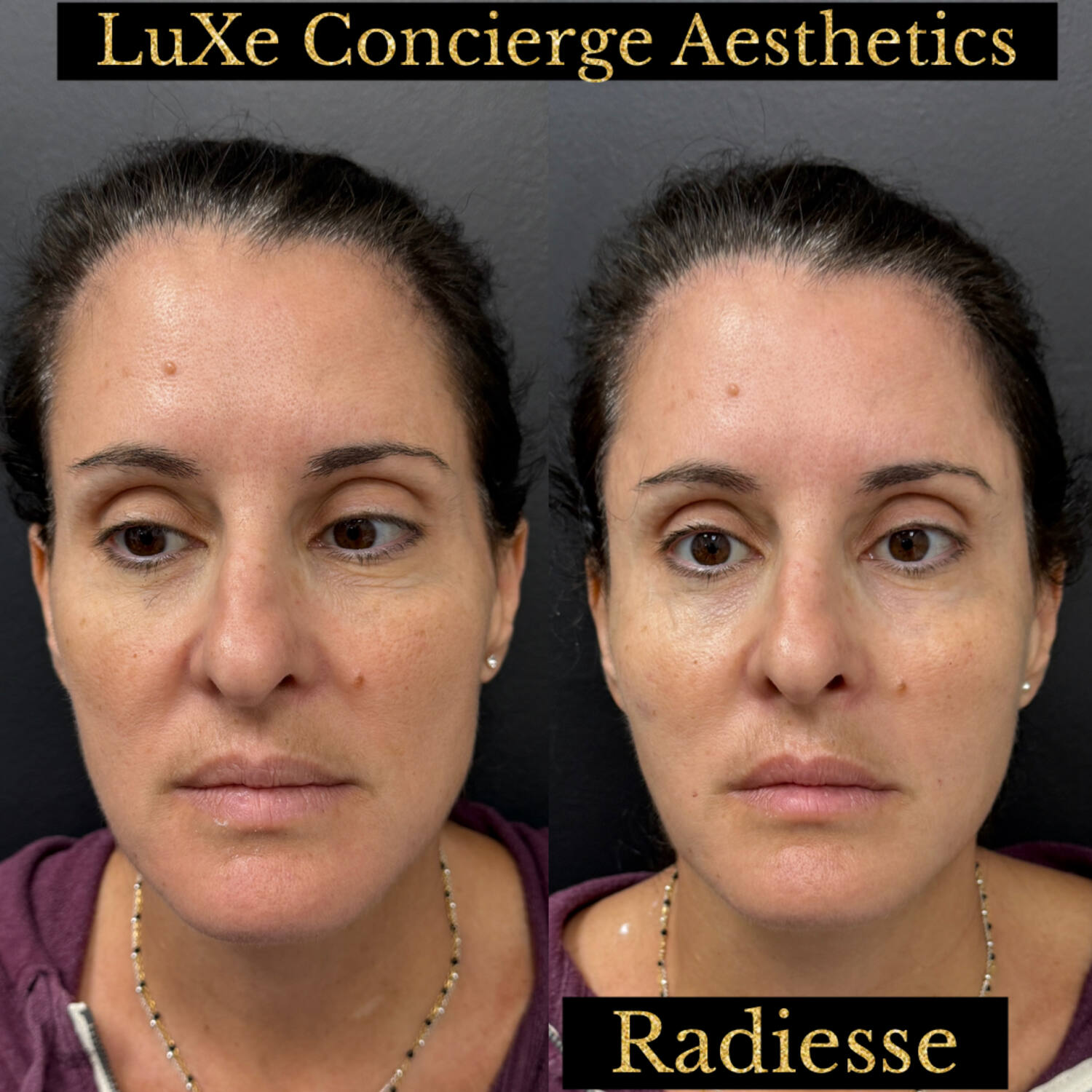 Biostimulator before and after — Radiesse, Dilute Radiesse and EZ Gel results at LuXe Concierge Aesthetics, Davie FL
