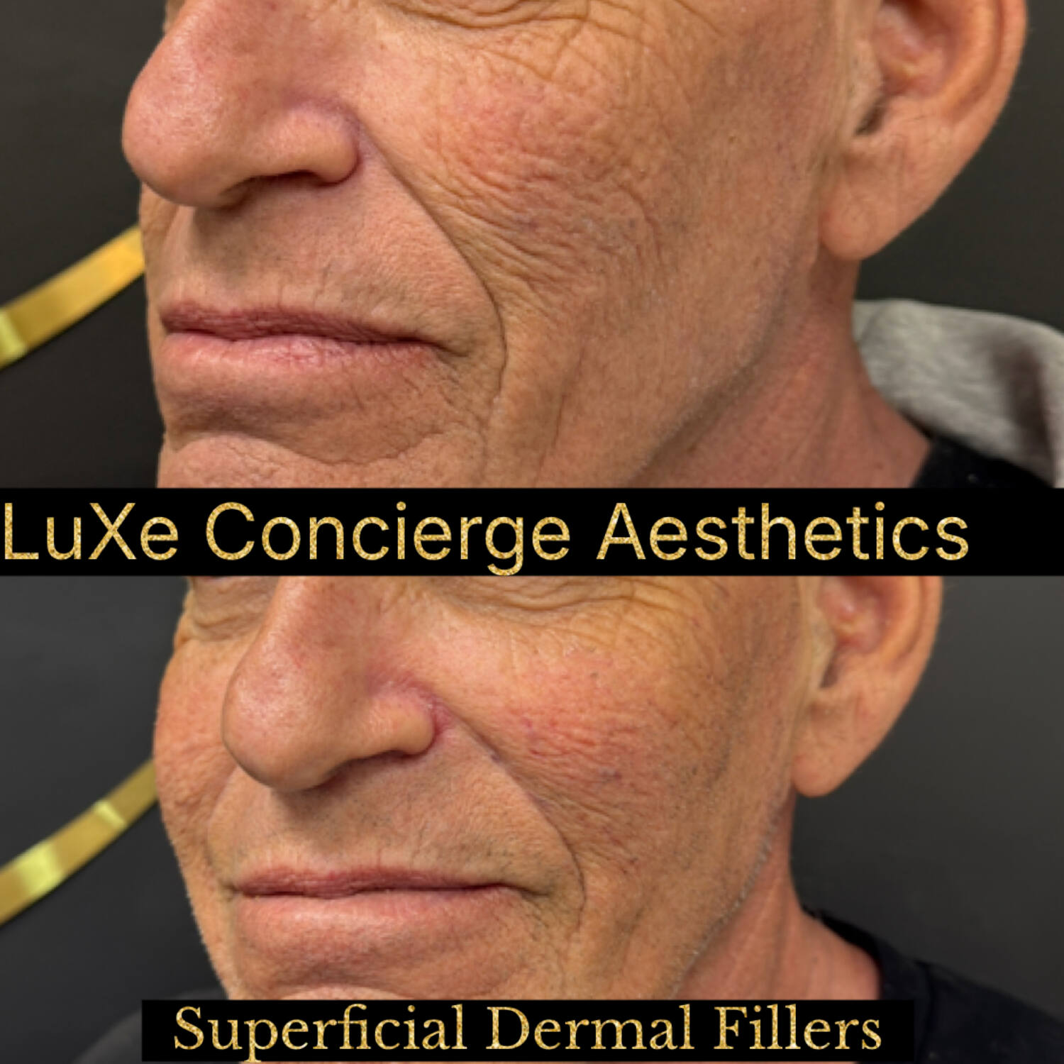 Dermal filler and facial balancing before and after at LuXe Concierge Aesthetics, Davie FL