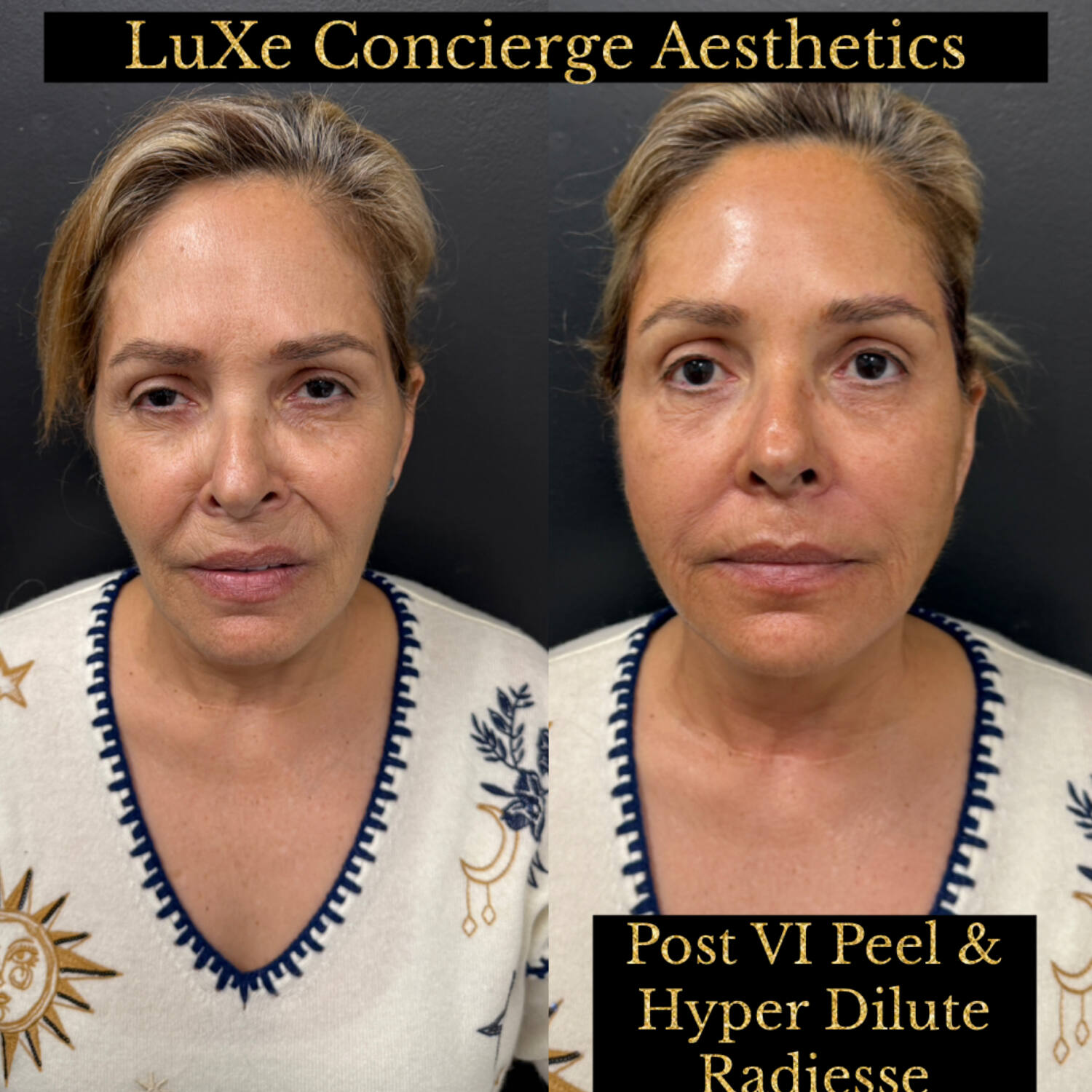 Biostimulator before and after — Radiesse, Dilute Radiesse and EZ Gel results at LuXe Concierge Aesthetics, Davie FL
