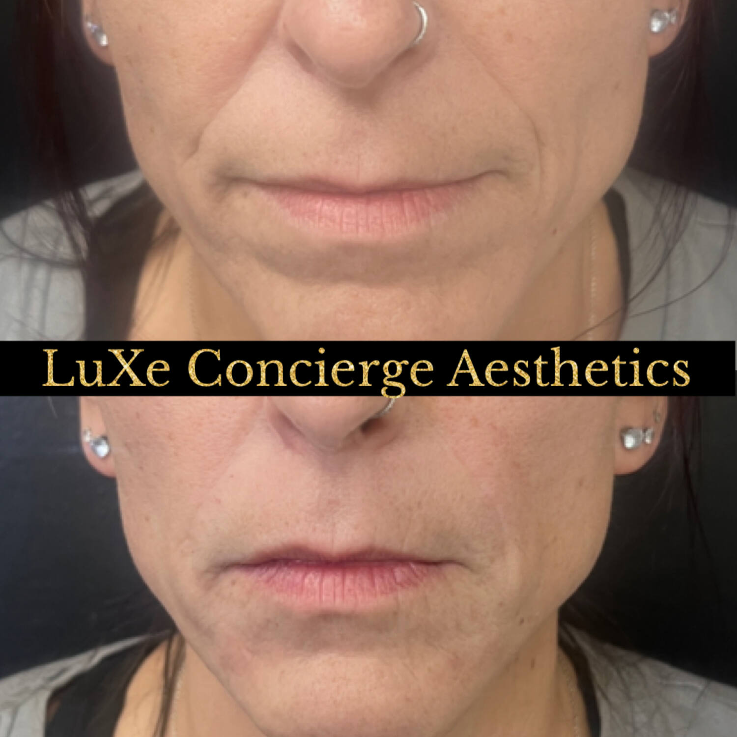 Dermal filler and facial balancing before and after at LuXe Concierge Aesthetics, Davie FL