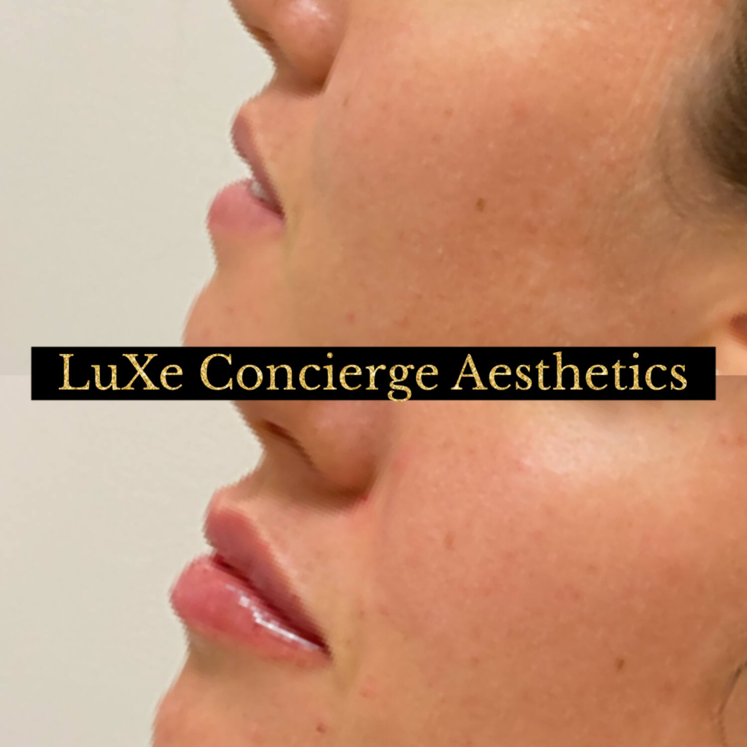 Dermal filler and facial balancing before and after at LuXe Concierge Aesthetics, Davie FL