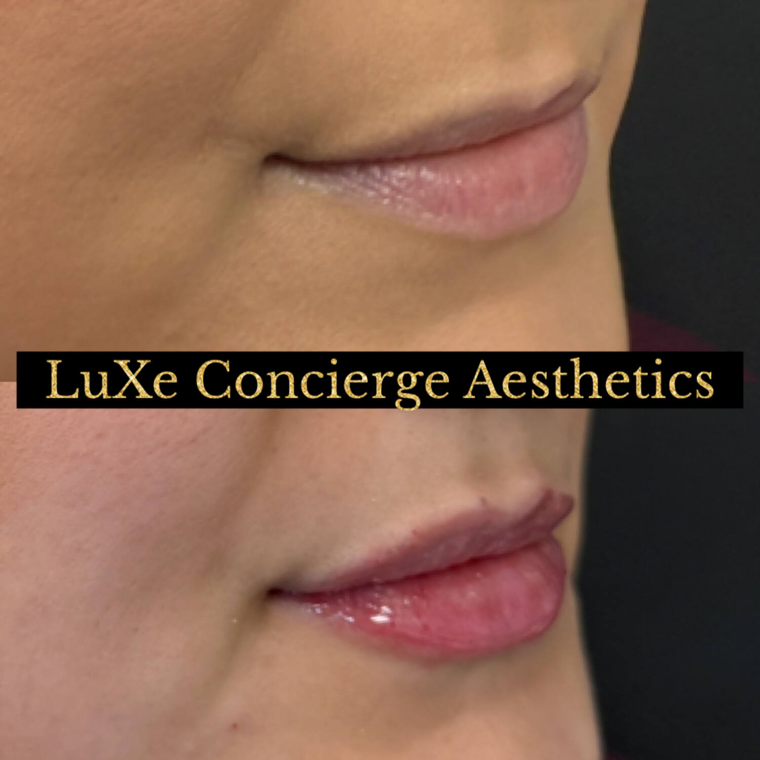 Dermal filler and facial balancing before and after at LuXe Concierge Aesthetics, Davie FL