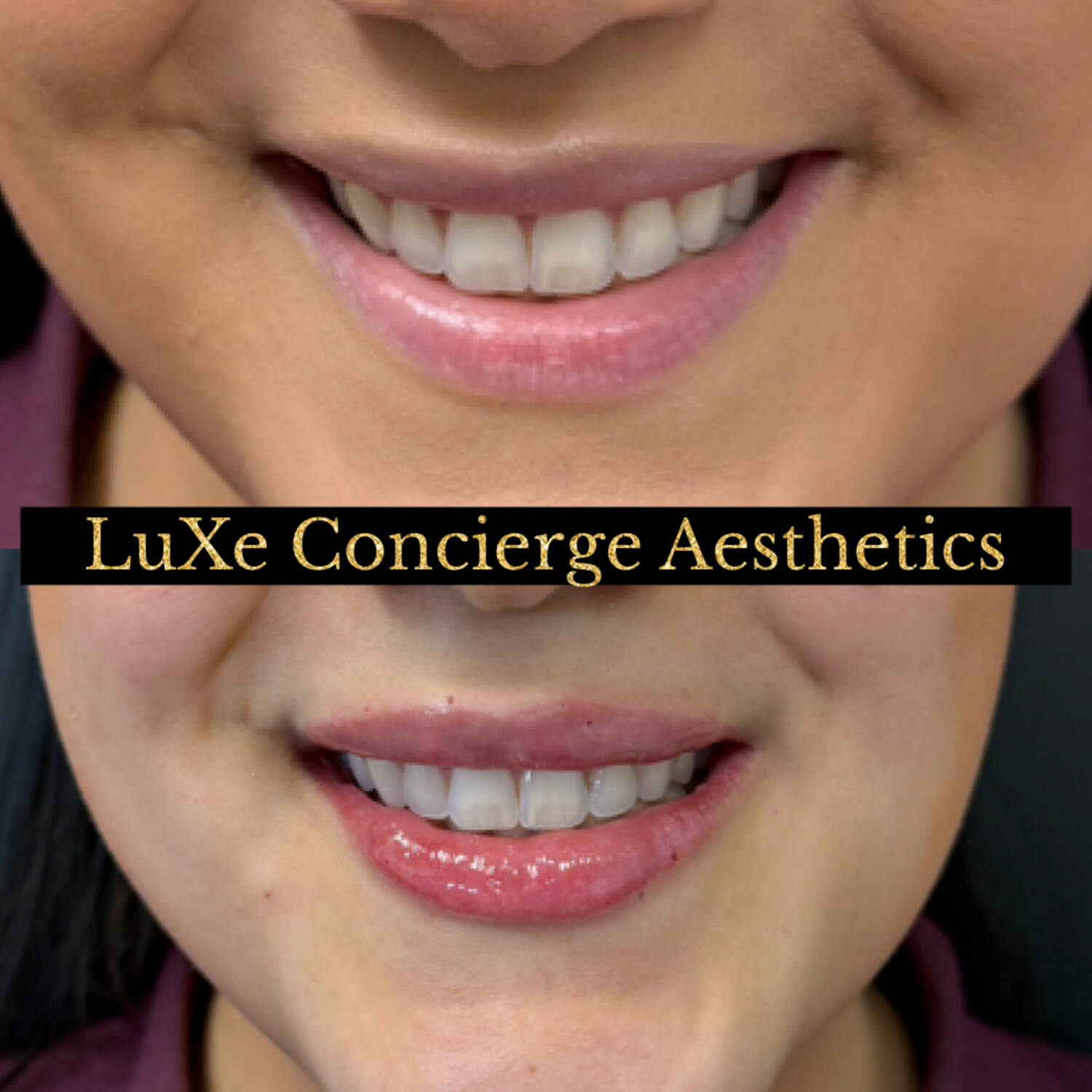 Dermal filler and facial balancing before and after at LuXe Concierge Aesthetics, Davie FL