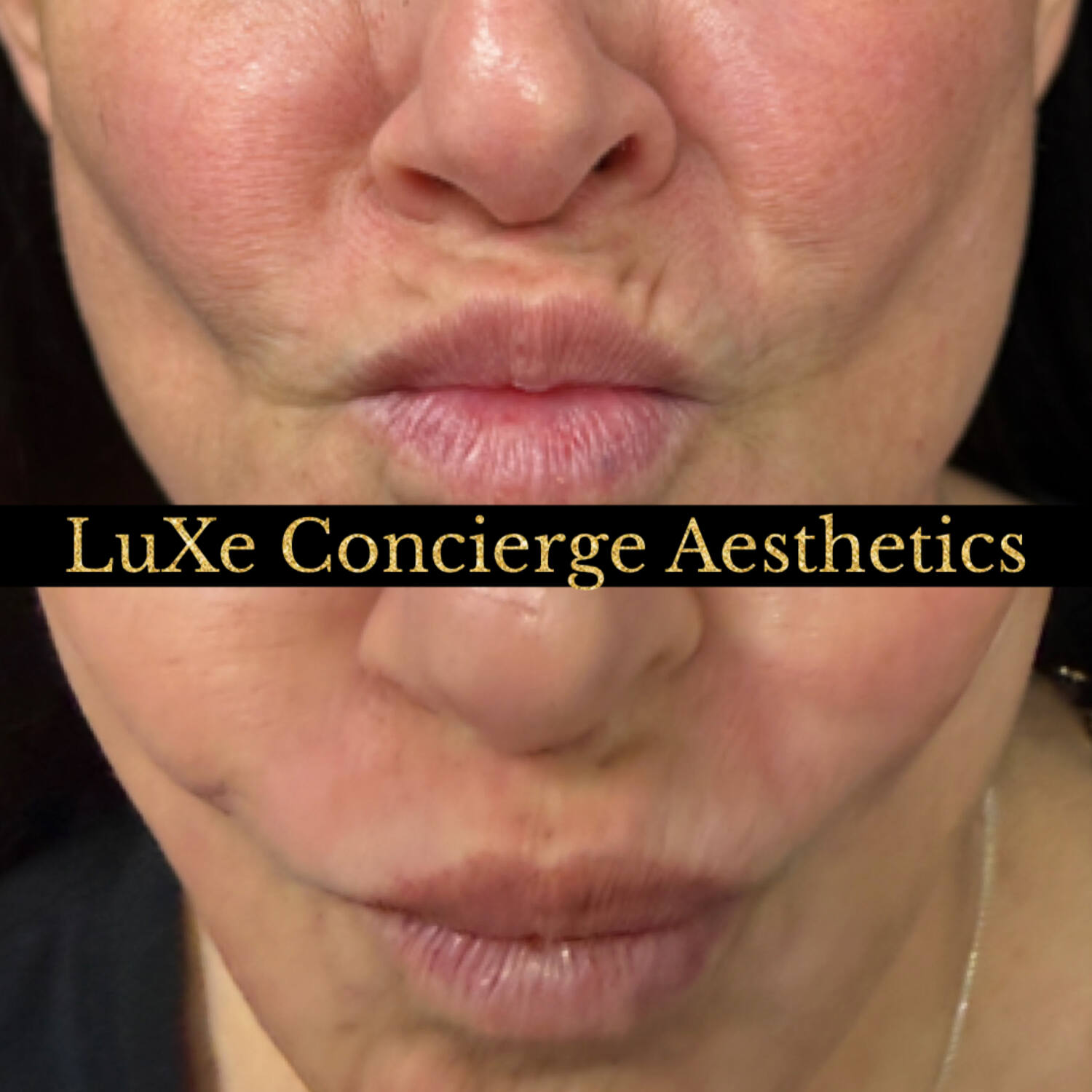 Dermal filler and facial balancing before and after at LuXe Concierge Aesthetics, Davie FL