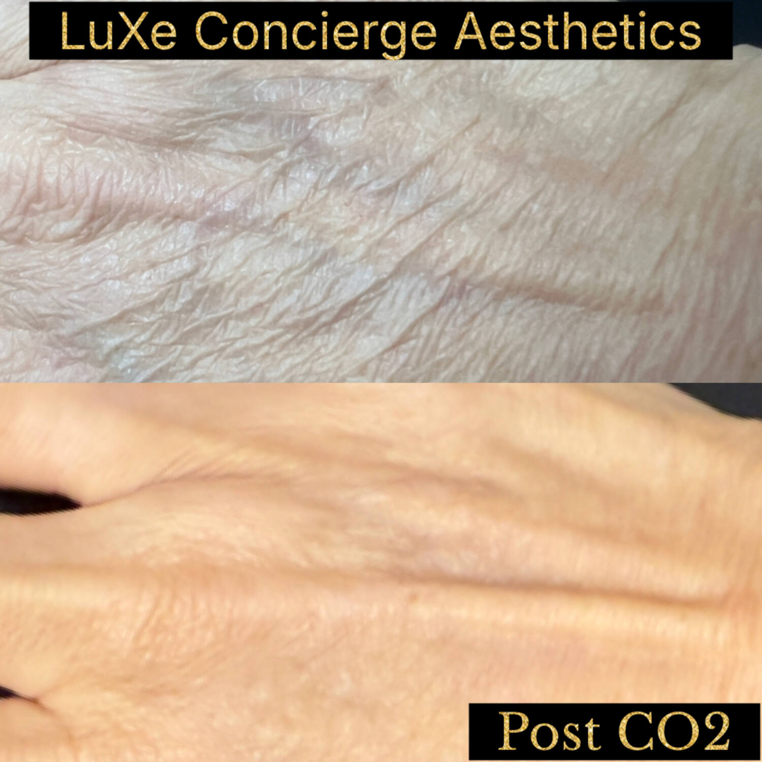 Fractional CO2 laser hand rejuvenation before and after at LuXe Concierge Aesthetics, Davie FL