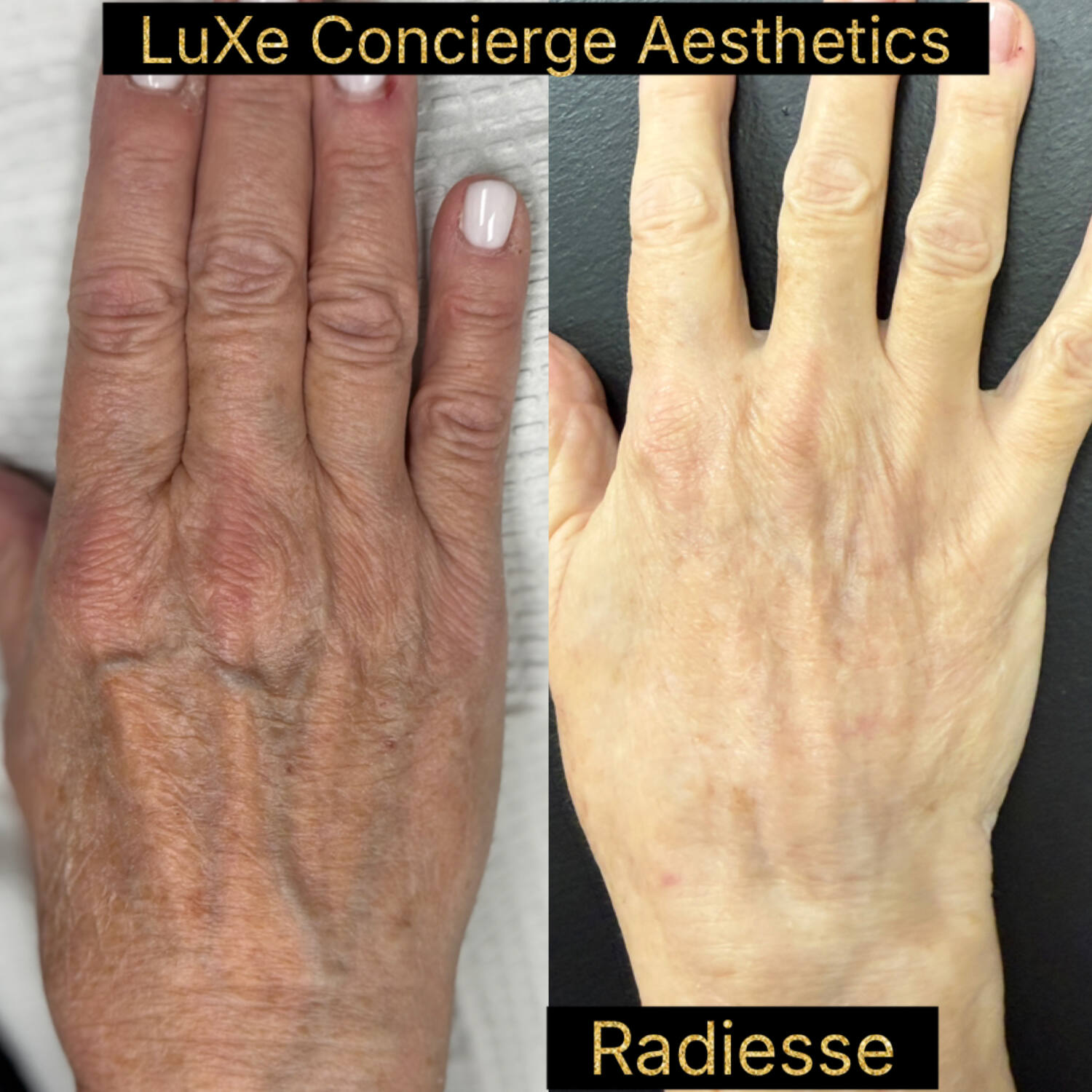 Hand rejuvenation before and after with Hyperdilute Radiesse at LuXe Concierge Aesthetics, Davie FL