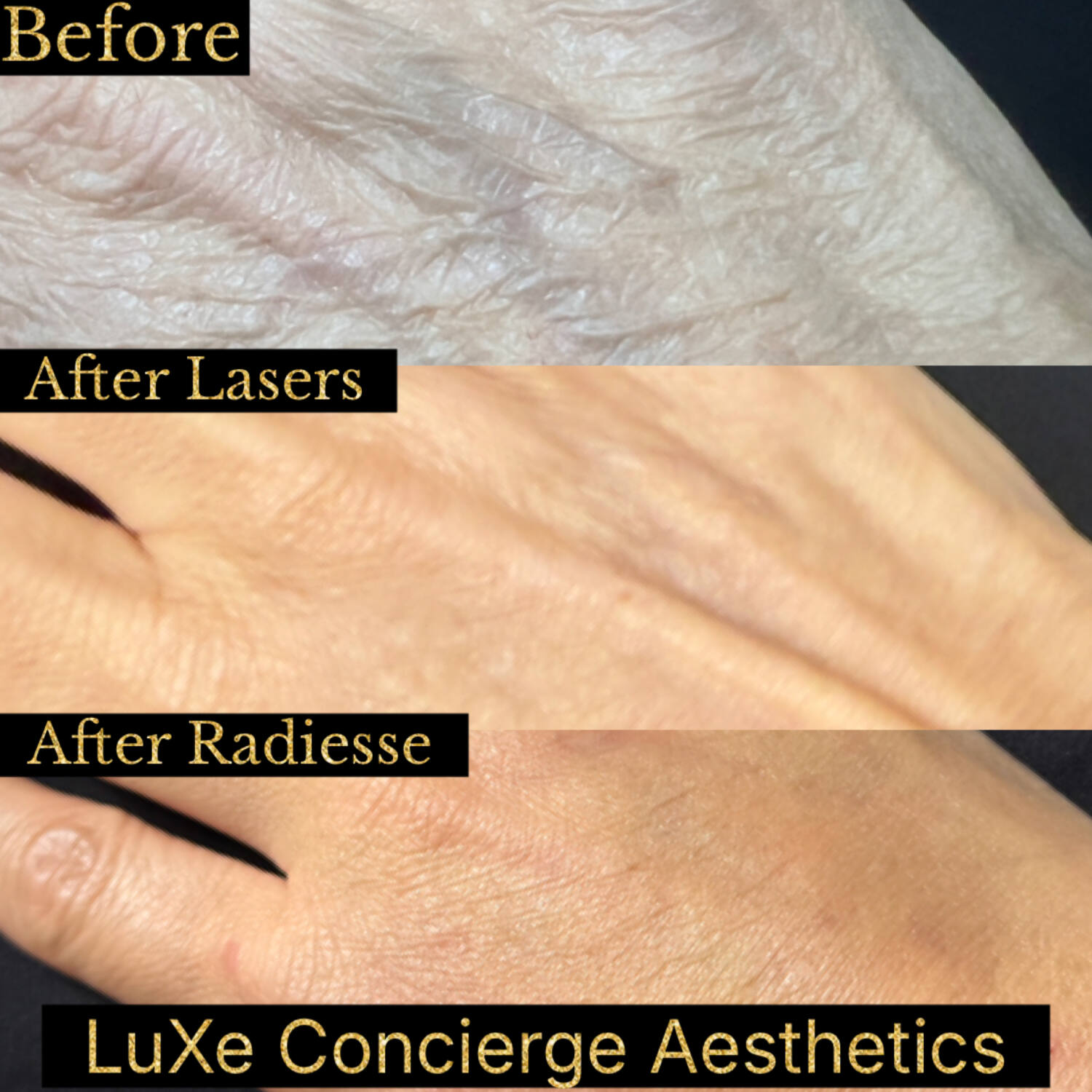 Hand rejuvenation before, after CO2 laser, and after Radiesse combination — LuXe Concierge Aesthetics, Davie FL