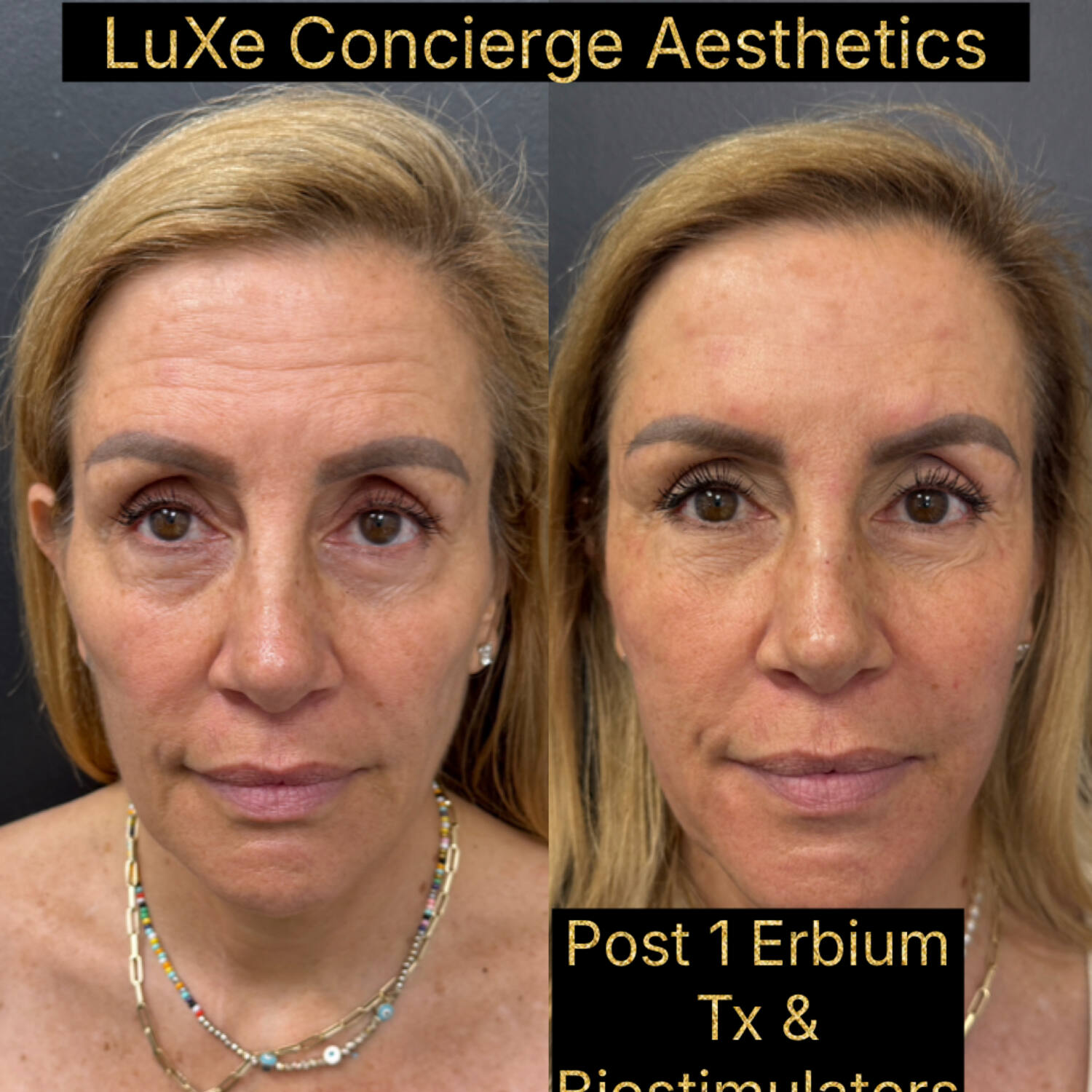 Erbium laser and biostimulator before and after, facial rejuvenation at LuXe Concierge Aesthetics, Davie FL