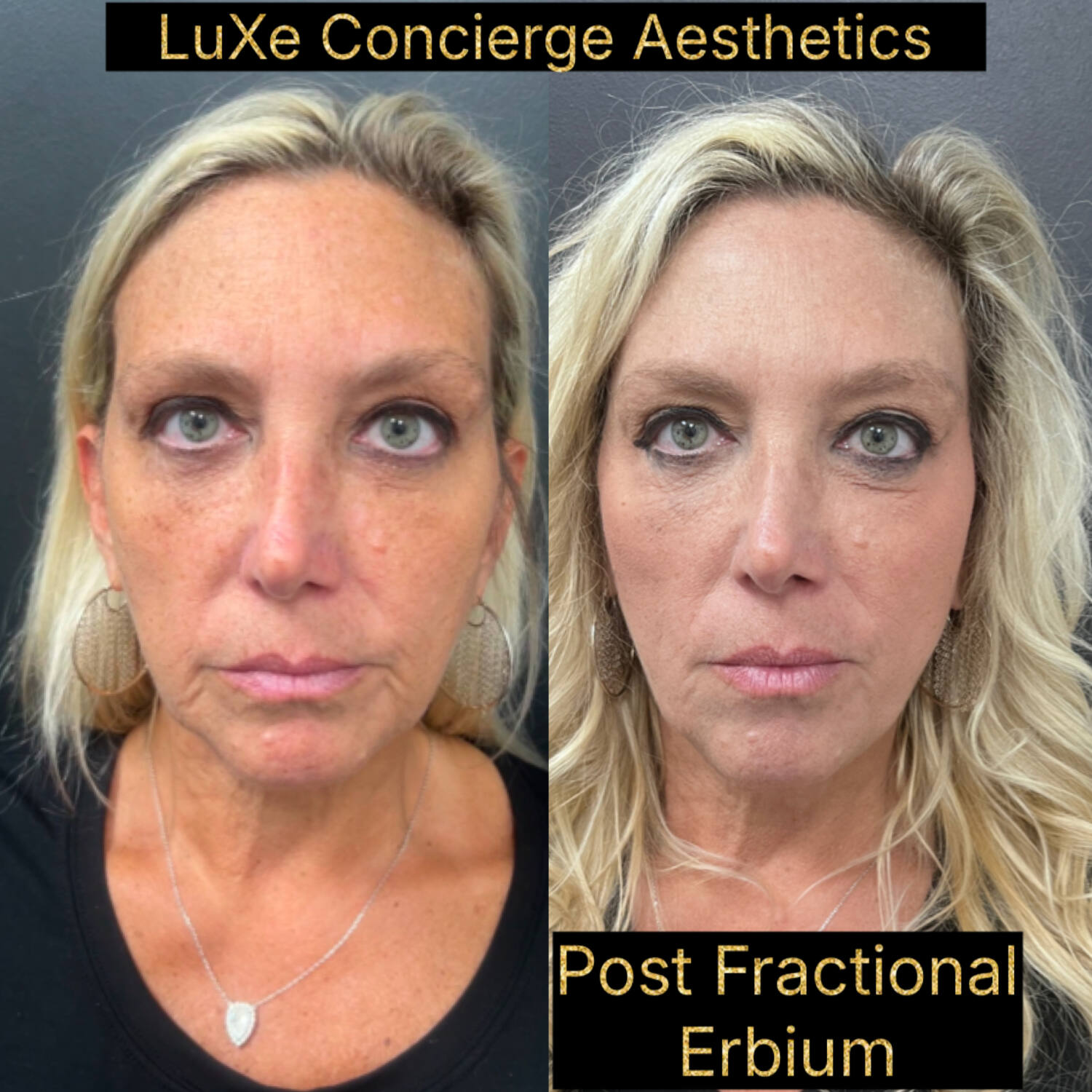 Fractional Erbium laser before and after, facial skin resurfacing at LuXe Concierge Aesthetics, Davie FL