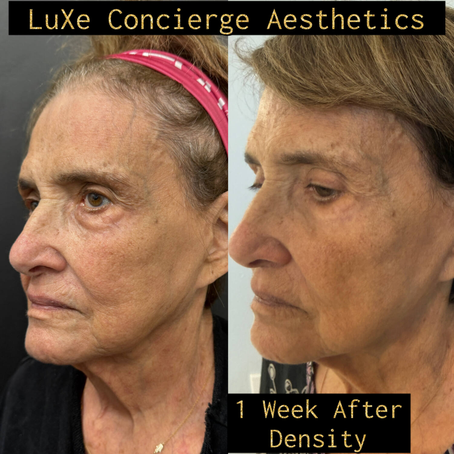 Density by Jeisys RF skin tightening before and after — 1 week results at LuXe Concierge Aesthetics, Davie FL