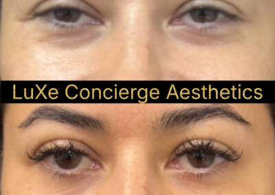 Biostimulators (Radiesse, Sculptra, EZGel, EZ PRF) before-and-after gallery photo at LuXe Concierge Aesthetics, Davie FL