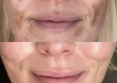 Melasma and pigmentation treatment before-and-after gallery photo at LuXe Concierge Aesthetics, Davie FL