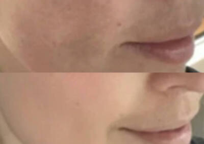 Melasma and pigmentation treatment before-and-after gallery photo at LuXe Concierge Aesthetics, Davie FL