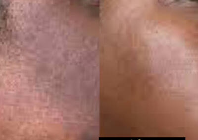 Melasma and pigmentation treatment before-and-after gallery photo at LuXe Concierge Aesthetics, Davie FL