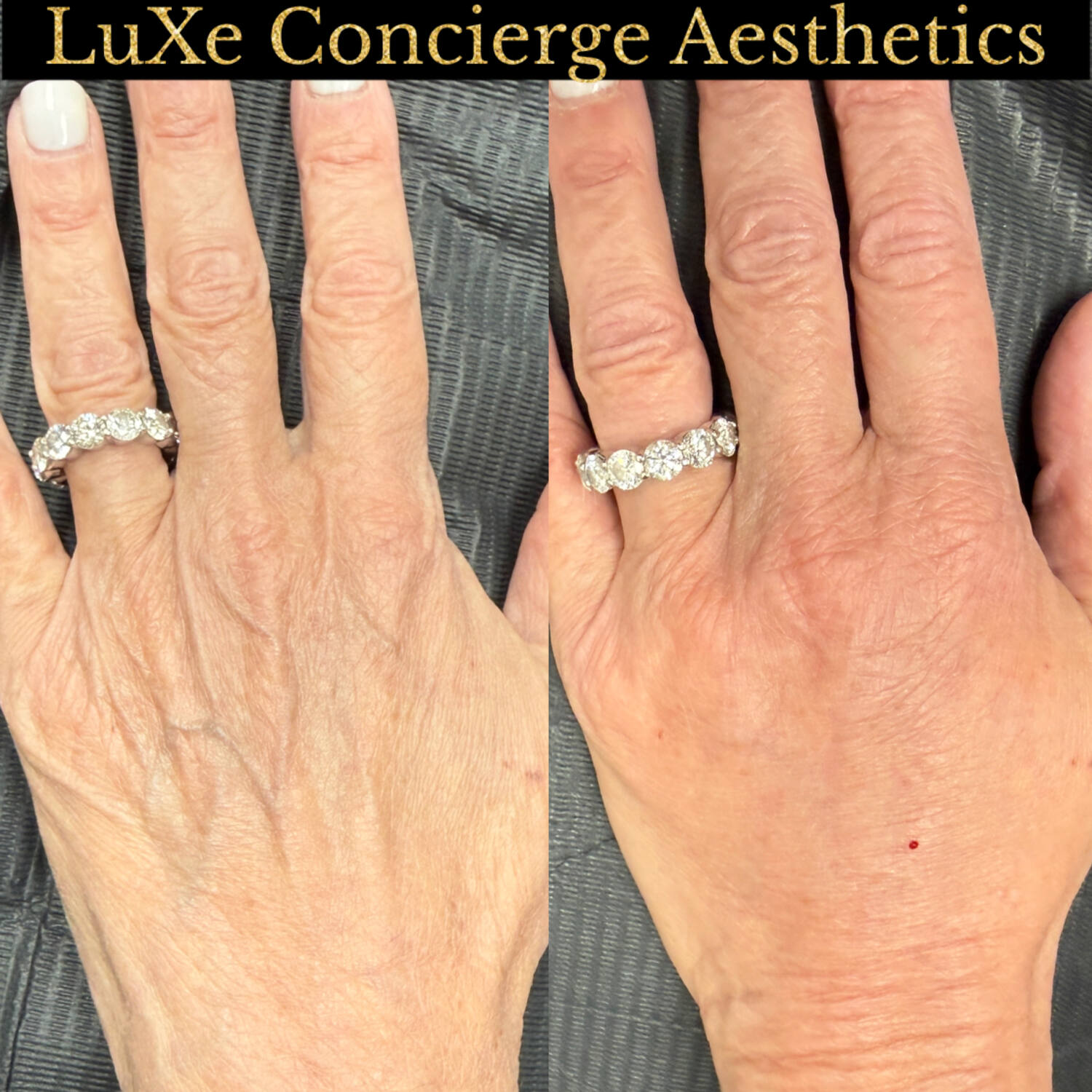 Biostimulator before and after — Radiesse, Dilute Radiesse and EZ Gel results at LuXe Concierge Aesthetics, Davie FL