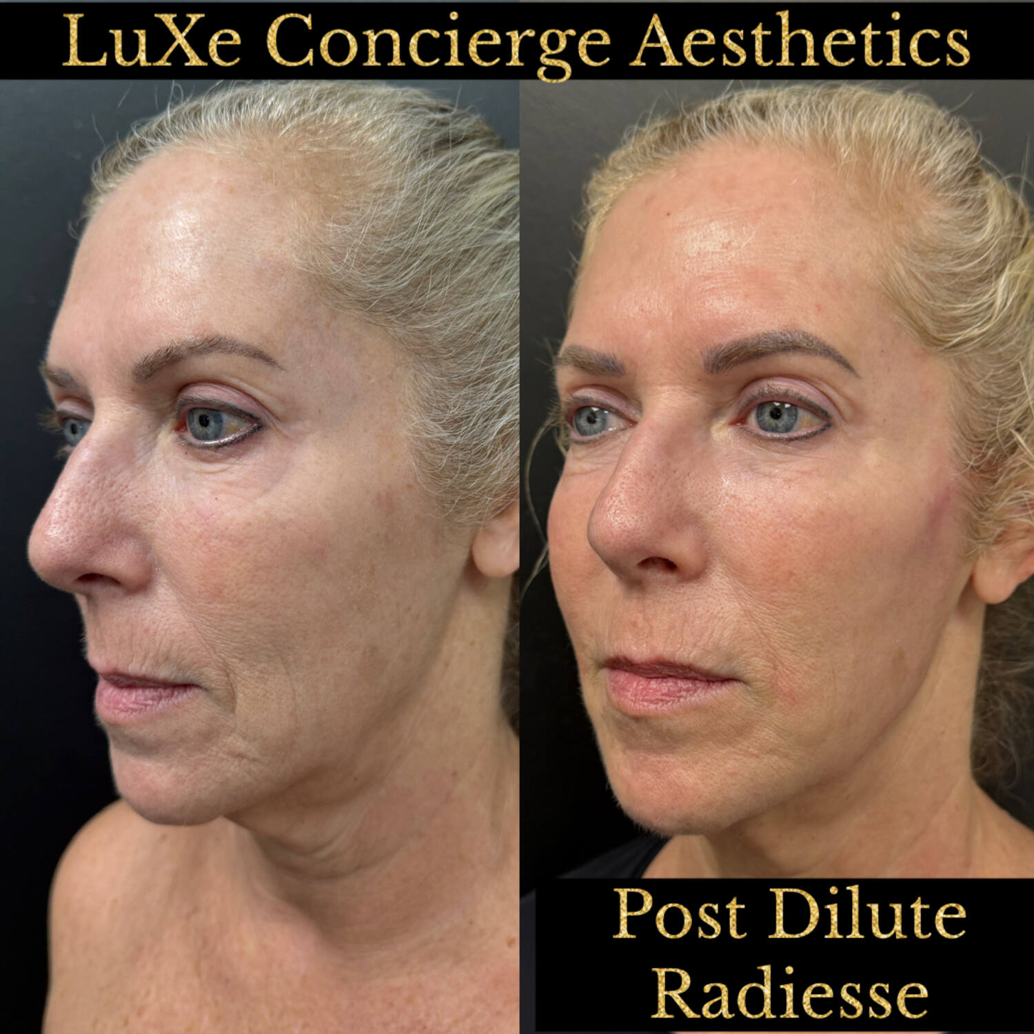 Biostimulator before and after — Radiesse, Dilute Radiesse and EZ Gel results at LuXe Concierge Aesthetics, Davie FL