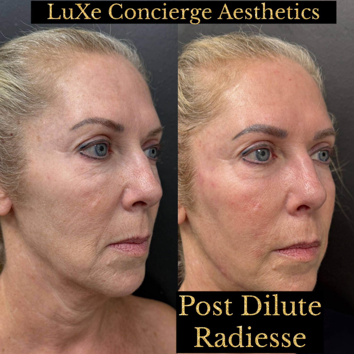 Biostimulator before and after — Radiesse, Dilute Radiesse and EZ Gel results at LuXe Concierge Aesthetics, Davie FL