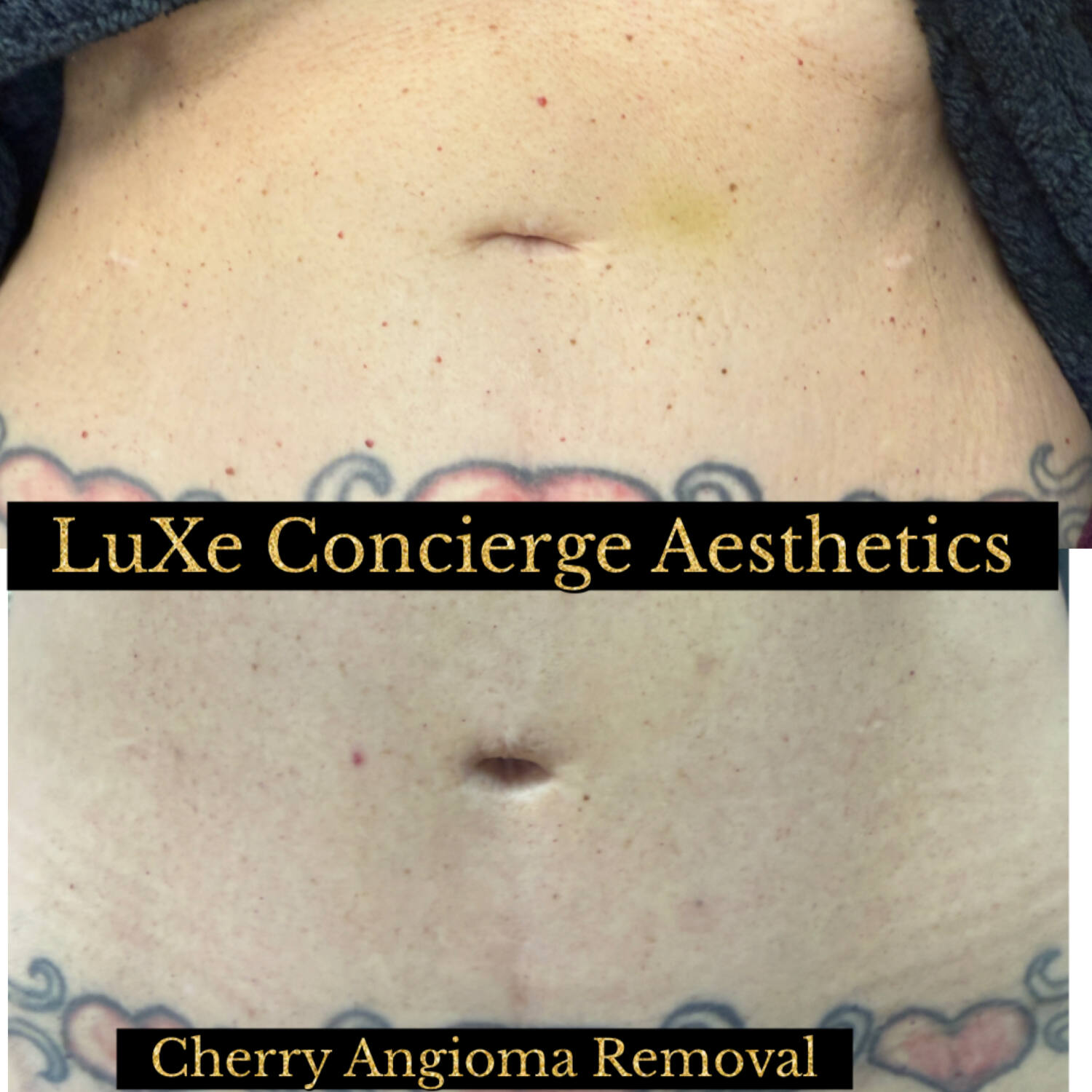 cheryyngiomas