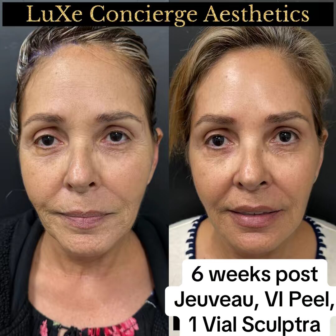 sculptra result